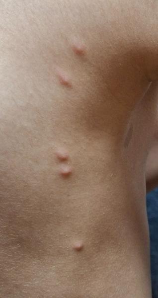 Co způsobuje neznámé štípance na těle?