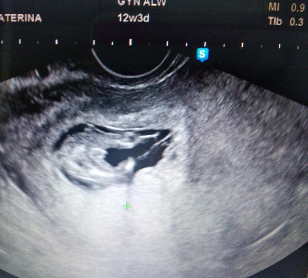 Chlapeček nebo holčička. Co myslíte?