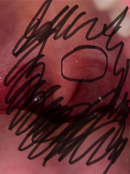 Boulička u mandle. Je to důvod k obavám?