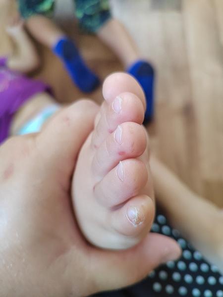 Divné pupínky u dítěte: Může to být nemoc ruka noha ústa?