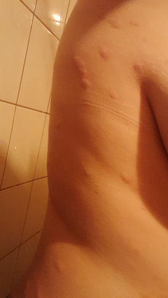 Svědivé pupínky po těle: Jaké jsou možné příčiny?