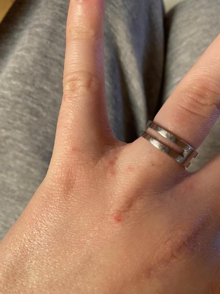 Jak rozlišit mezi alergií a svrabem? Zkušenosti a rady