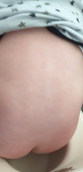 Ekzém. Může se o něj jednat, nebo je to jiná vyrážka?