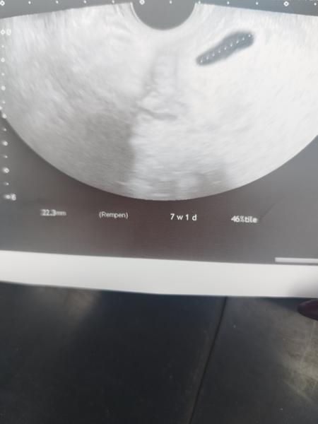 Kontrola v 7. týdnu těhotenství: Kdo zažil podobnou situaci?