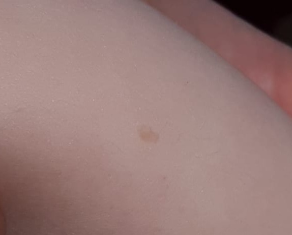 Neurofibromatóza. Je důvod k obavám? Jaká vyšetření jsou vhodná?