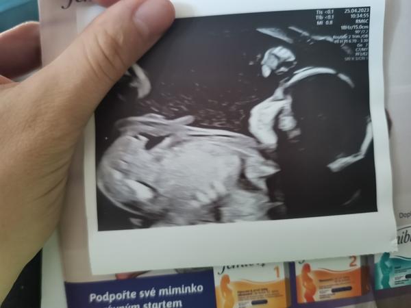 Je to holčička? Jak poznat pohlaví na ultrazvuku?