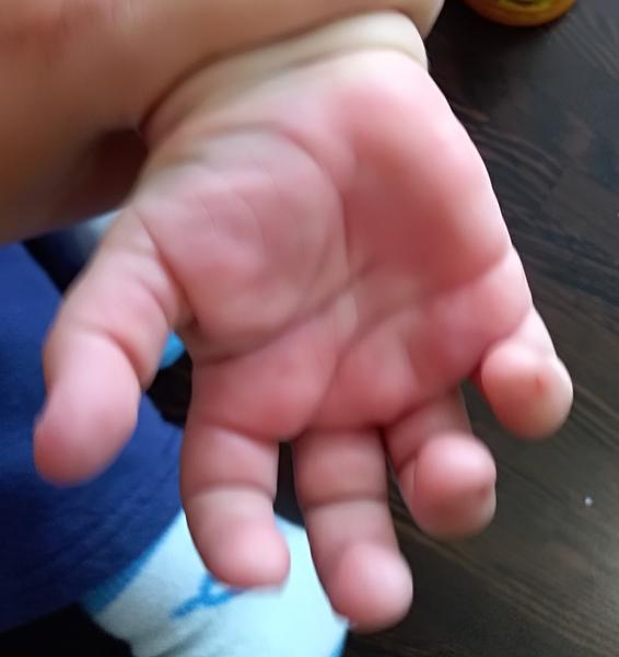 Vyrážka (ruce, nohy). Máte zkušenosti?