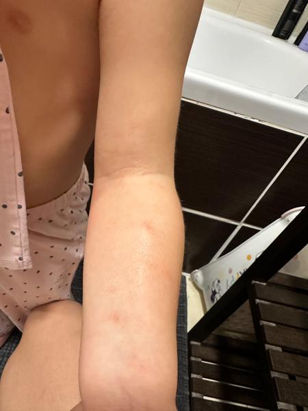 Vyrážka a teploty bez příznaků: Jaká nemoc by to mohla být?