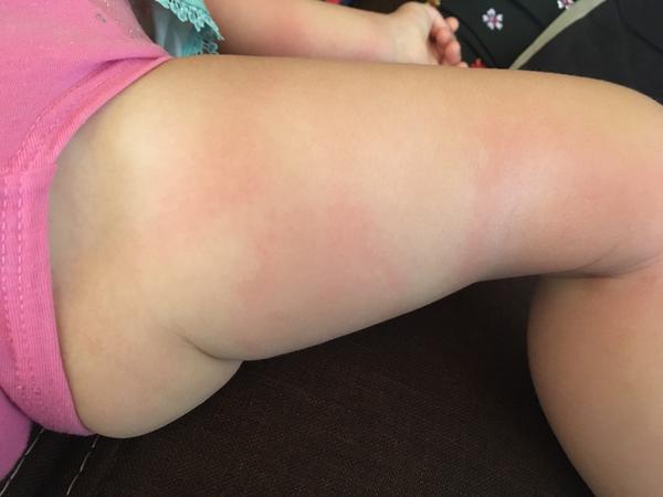 Fleky na noze. Mohla by to být borelióza? Nebo spíše alergie?