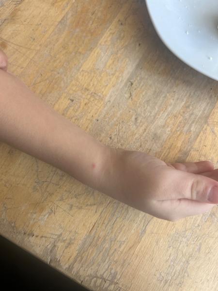 Červené fleky u syna. Jsou to neštovice?