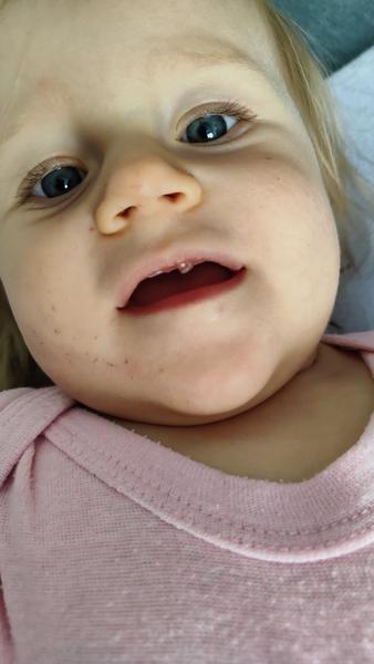 Je normální, že při růstu zubů dásně natečou?