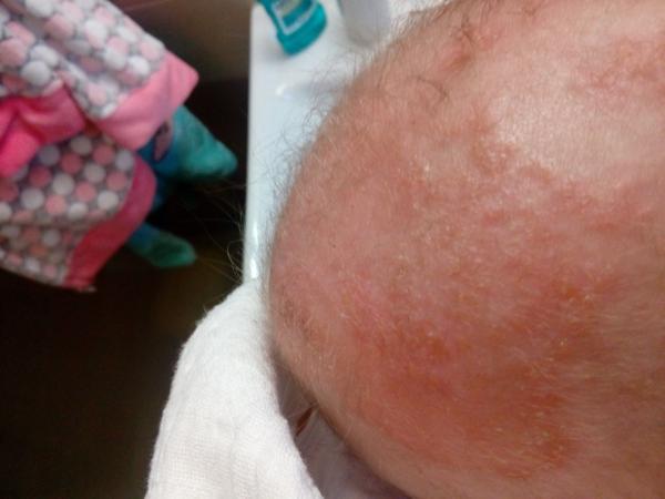 Ekzém u 4měsíčního miminka. Poradíte, prosím?