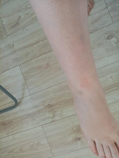 Modřiny na dolních končetinách - z čeho můžou být?