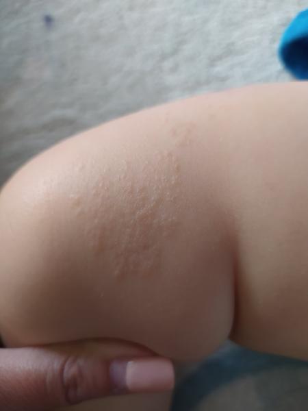 Pupínky slévající se v jeden velký flek. Mohlo by se jednat o ekzém?