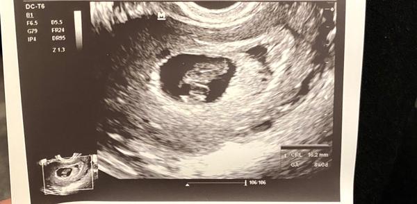 9. týden těhotenství. Odpovídá tomu velikost plodu?