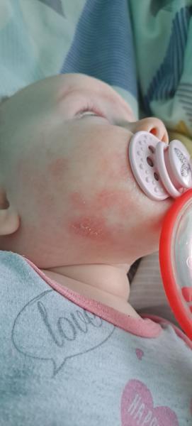 Červené fleky. Kvasinka nebo atopický ekzém?