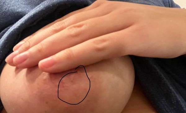 Drobná vráska na prsu. Může to být problém?