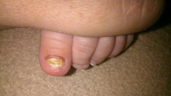 Zdeformovaný nehet u miminka, co s tím?