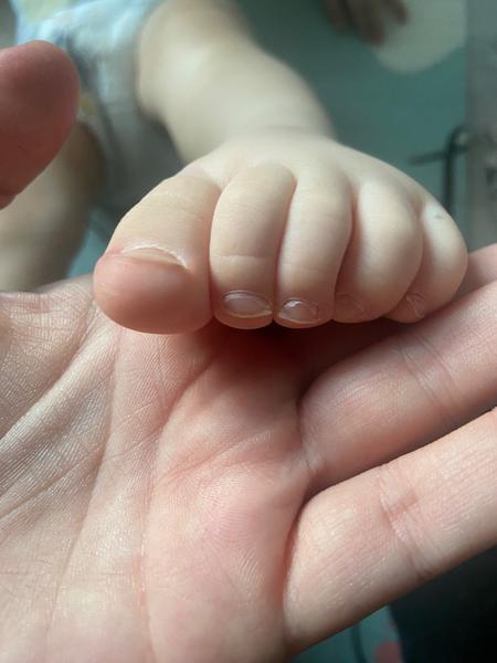 Drolící se nehty u sedmnáctiměsíčního dítěte. Máte zkušenost?