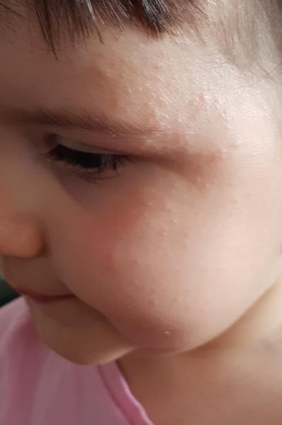 Co to je za vyrážku, nevíte?