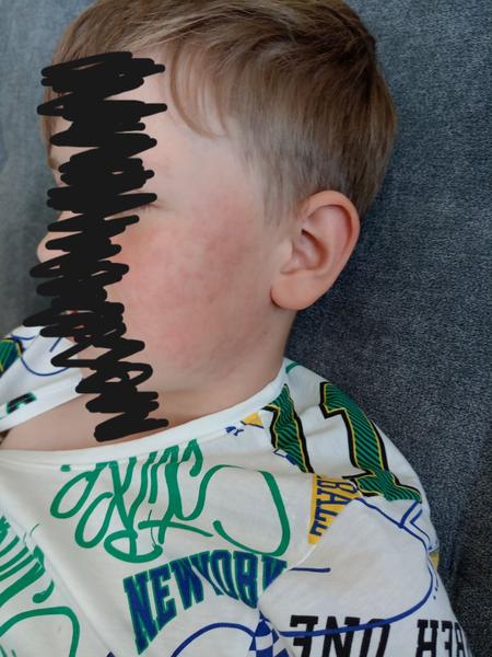 Vyrážka. Jedná se o pátou nemoc?