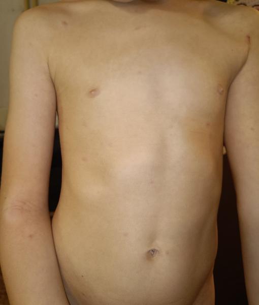 Jsou pupínky na těle příznakem neštovic?