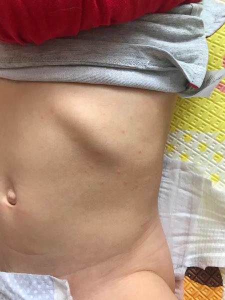 Vyrážka nebo ekzém. Co by to mohlo být? Volat naší dr.?