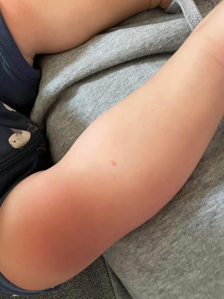 Pupínky na obličeji a těle. Jak zjistit příčinu?