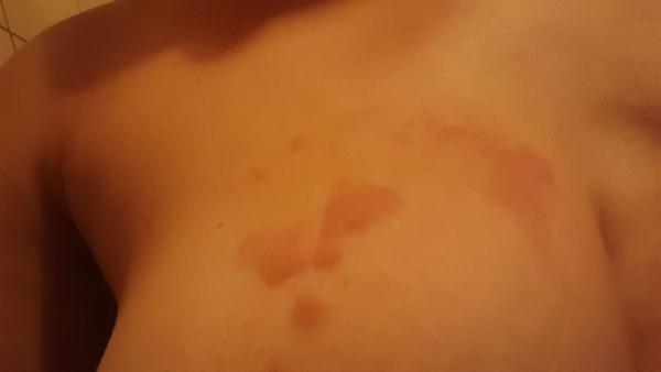 Svědivé pupínky po těle: Jaké jsou možné příčiny?