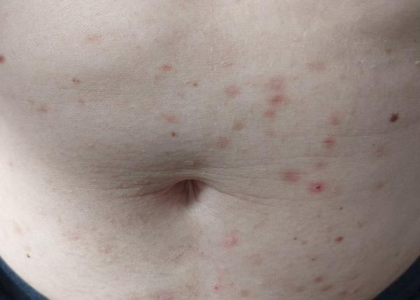 Jak se zbavit pupínků a jizev po nich?