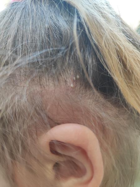 Pupínky ve vlasech u dětí. Co je může způsobovat?