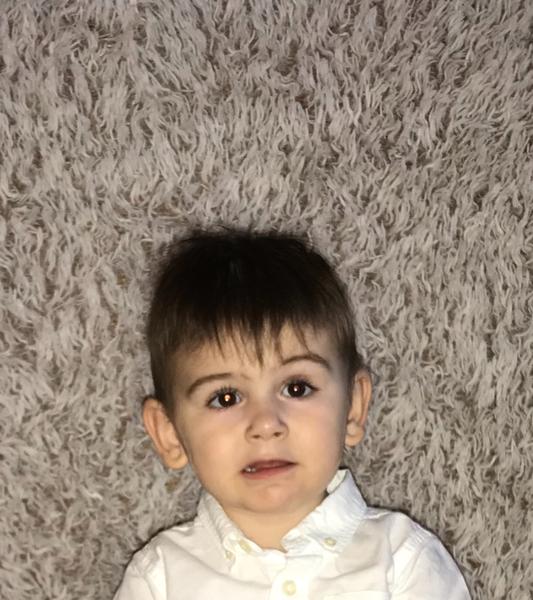 Ucpaný slzný kanálek. Je možné, že způsobuje odlesk v oku?