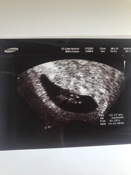 Co kde miminko na fotce z ultrazvuku má. Poznáte to některá?