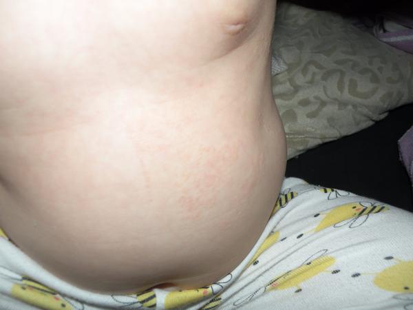 Ekzém/vyrážka, co by zabralo?