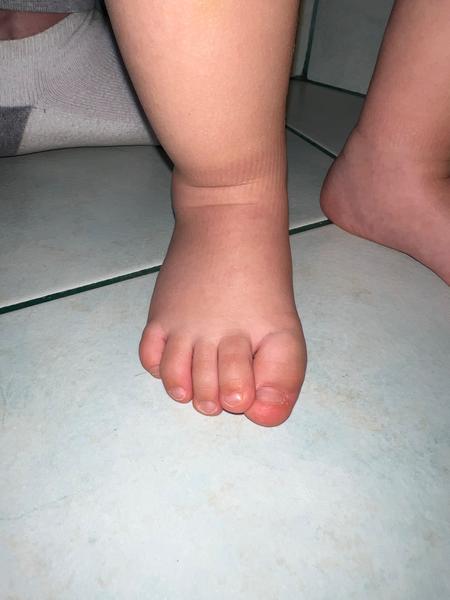16měsíční dítě. Vbočený palec nebo deformace chodidla?
