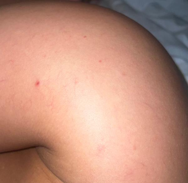 Co jsou červené pupínky na nohou?