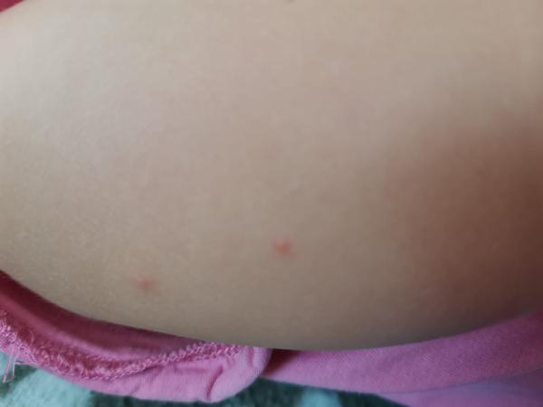 Jsou tyto příznaky opravdu neštovice?