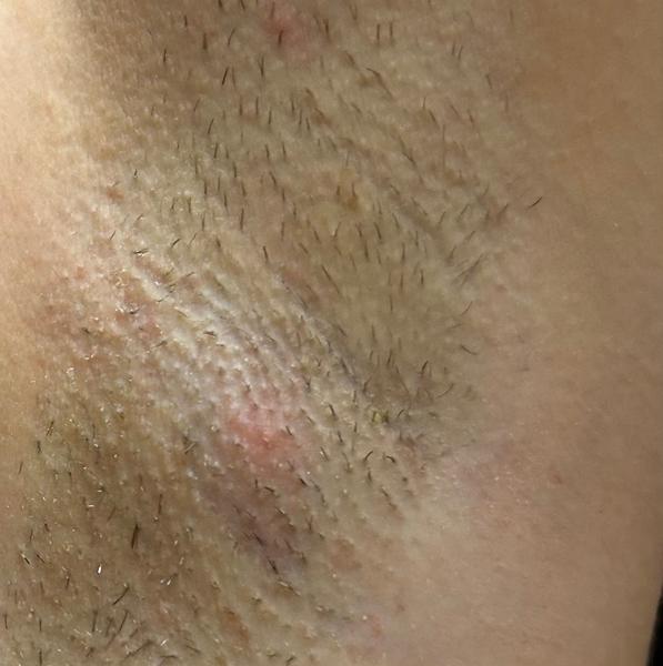 Bolest v podpaží. Může to být po holení a deodorantu?