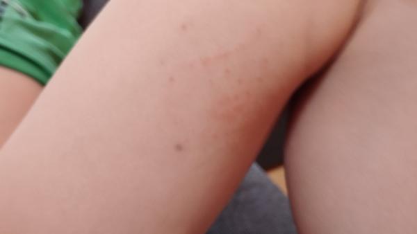 Fialové tečky na noze u syna. Co to může být?