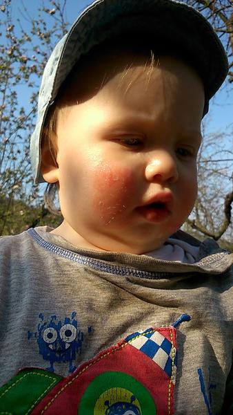 Ekzém na tvářičkách u roční dcerky. Poradíte, prosím, jak změnit stravování?