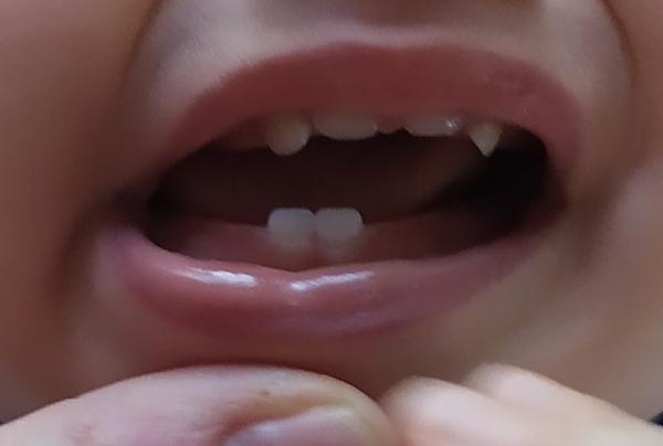 Skus zubů a čelist. Jedná se o nějakou čelistní vadu?