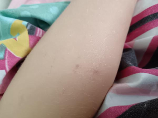 Co může znamenat podobná vyrážka u dítěte?