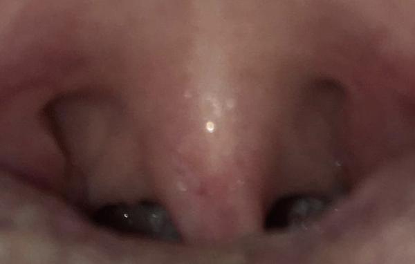 Nemoc. Co mohou být tyto tečky vzadu v krku?