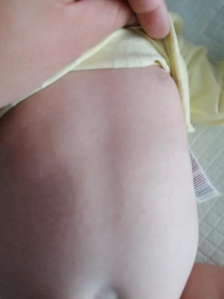 Vyrážka. O co se může jednat?