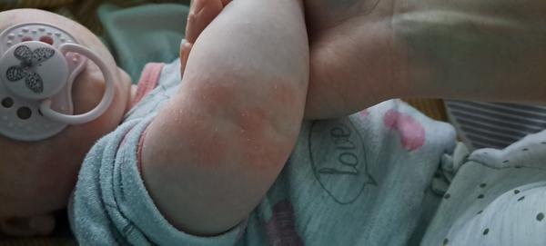 Červené fleky. Kvasinka nebo atopický ekzém?