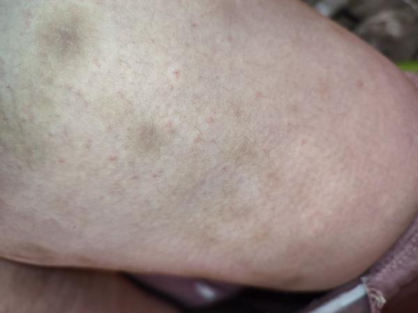 Co způsobuje vyrážku na stehnech a břichu?