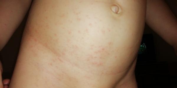 Nesvědivá vyrážka - může to být virové?