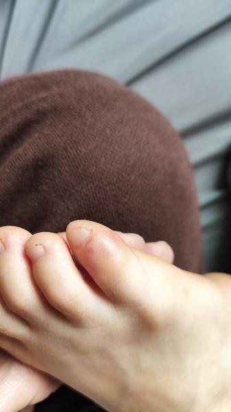 Je vyrážka na dlaních příznakem sedmé nemoci?