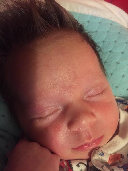 Vyrážka. Jsou to potničky nebo alergie?