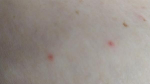 Vyrážka na břiše. Co by to mohlo být?